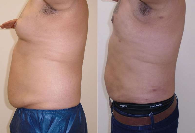 Chest before and after image in houston