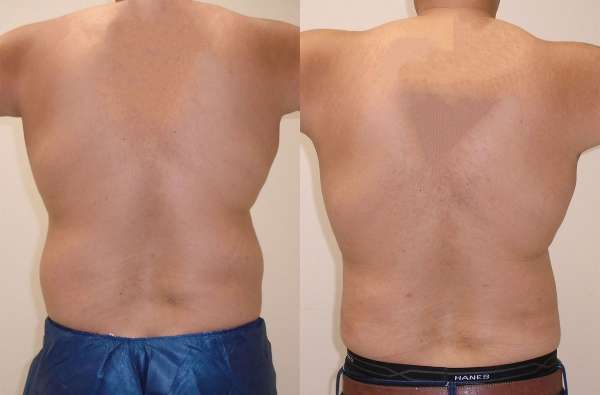 Liposuction Patient Back pain