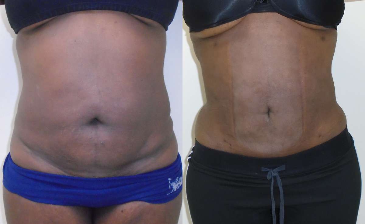 Downsize, Liposuction Before & After