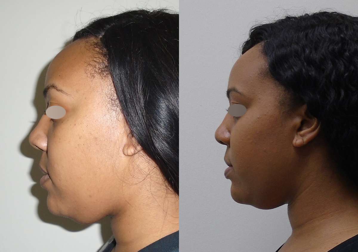 Liposuction Chin difference