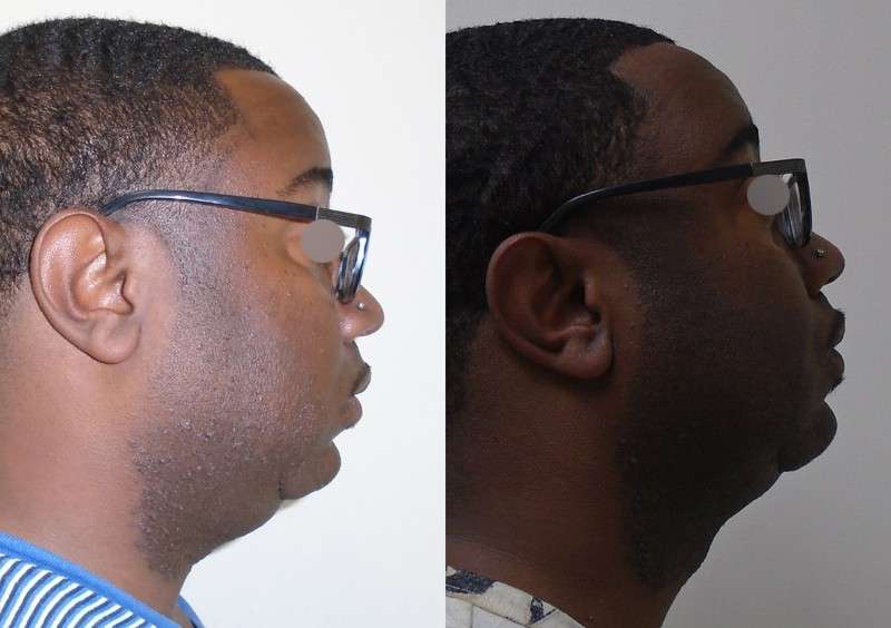 Before and after chin right side view in Houston