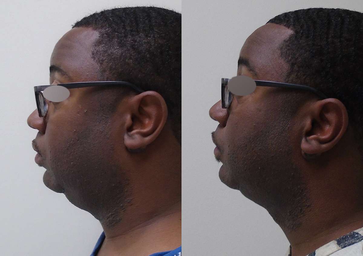 Before and after chin left side view in Houston