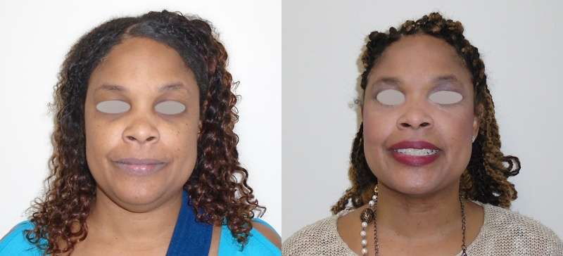 Chin liposuction before and after Houston, TX
