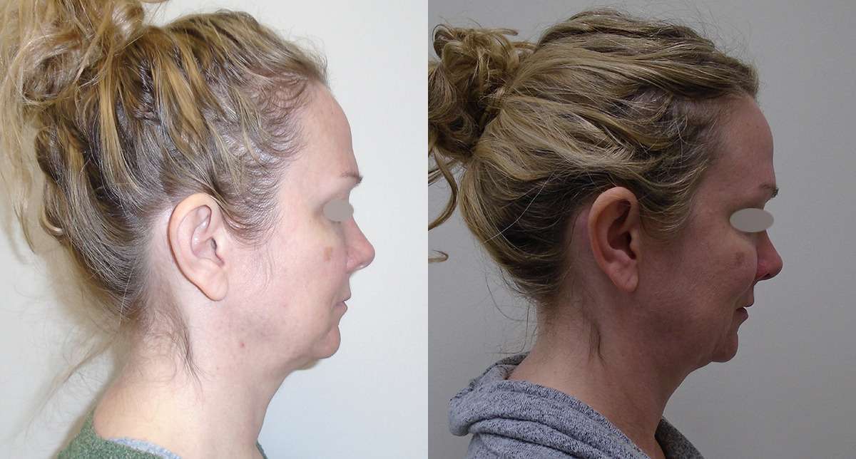 Chin treatment before and after