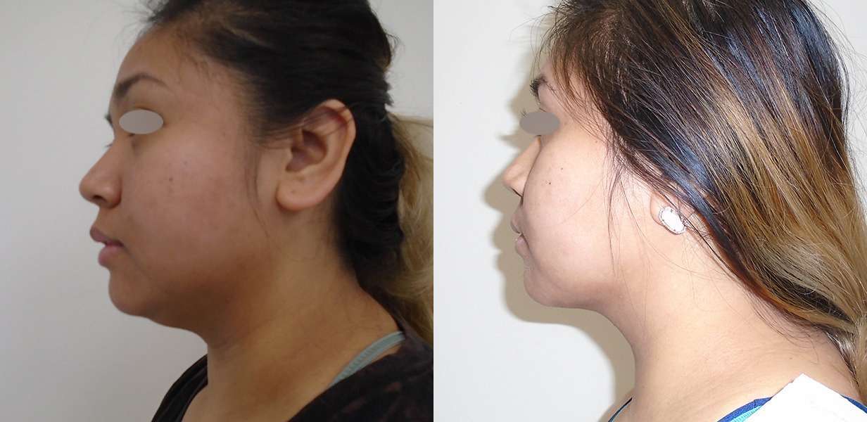 Before and after Chin treatment for lady
