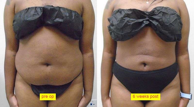 Liposuction 360 Before and After Photo by Dr. Hennessy in Houston TX