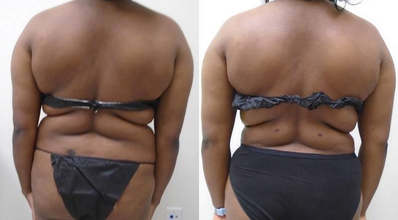 Treatment of middle back in Downsize lipo center
