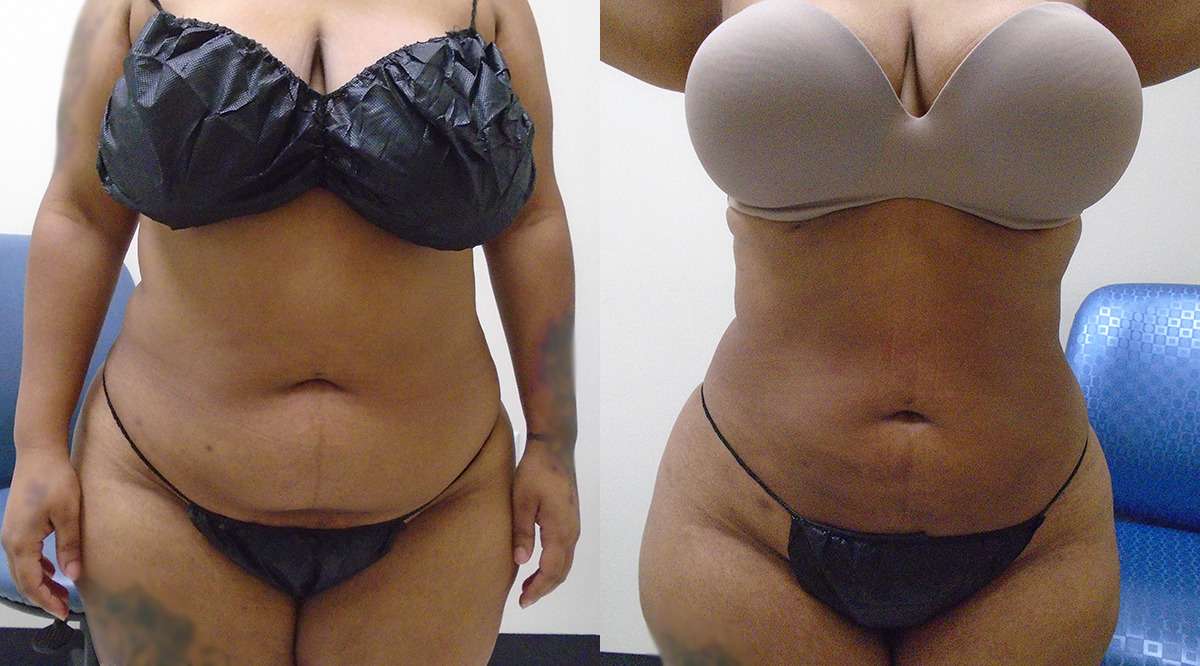 Before and after liposuction difference in houston