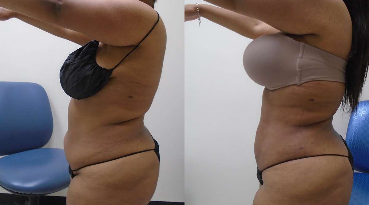 Liposuction before and after transformation in houston