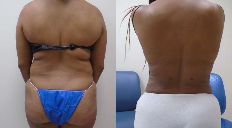 Downsize liposuction back pose before and after Houston, TX