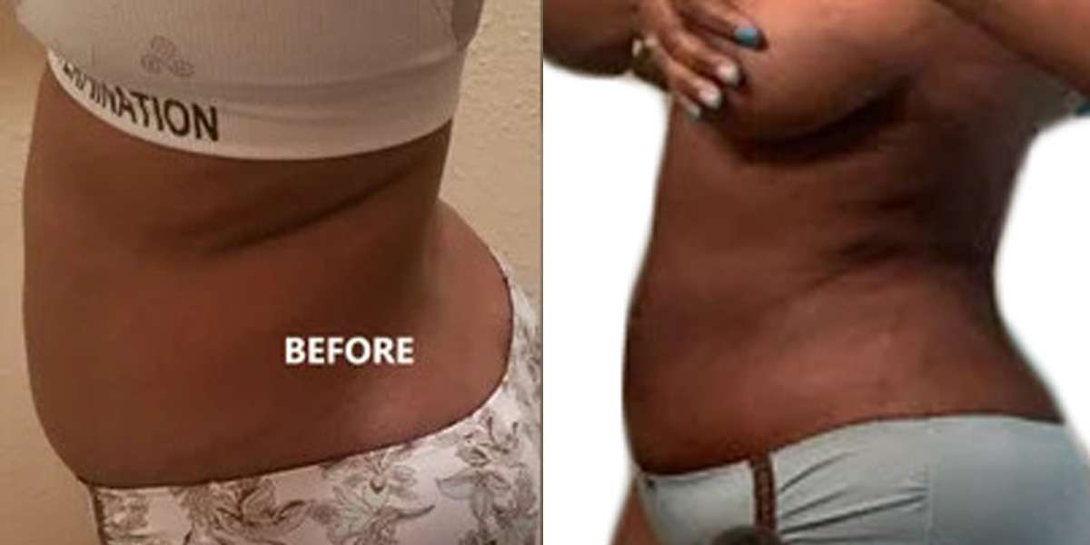 Downsize, Liposuction Before & After