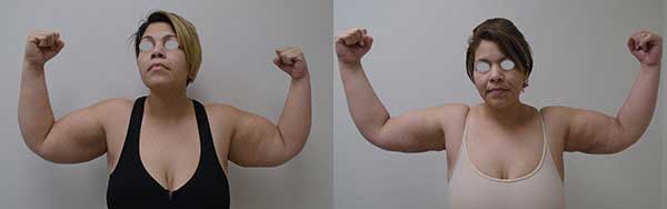 Before and after image of arms treatment