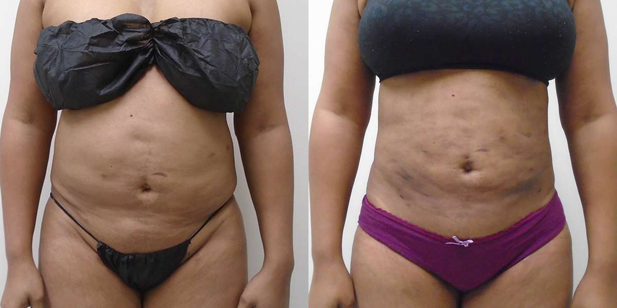 Liposuction body before and after image Houston, TX