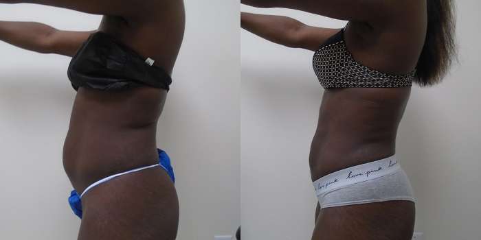 Transformation of liposuction