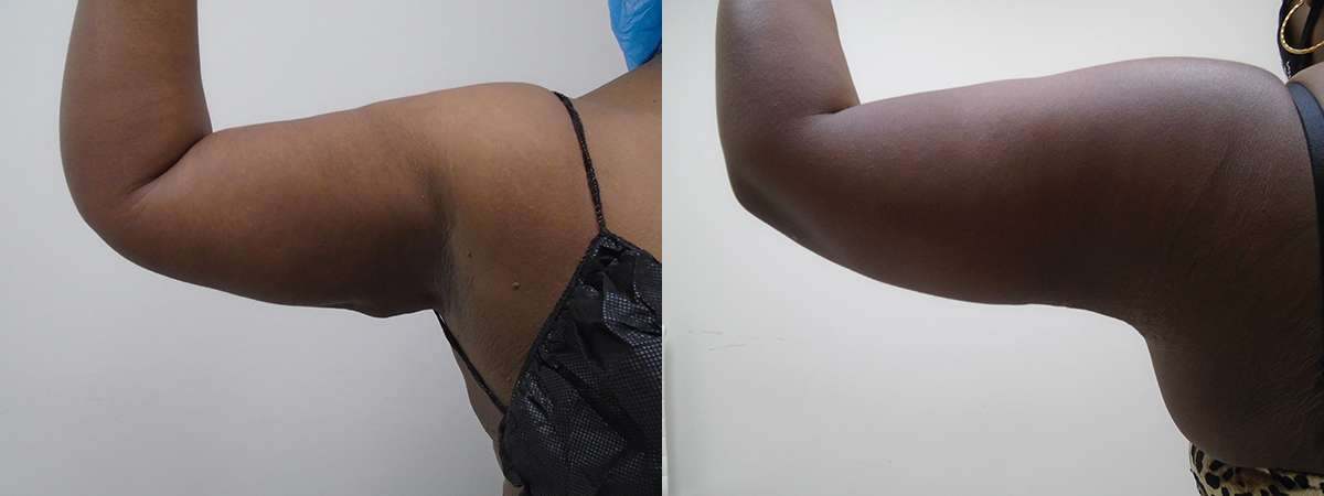 Before and after Right Arm Downsize Lipo