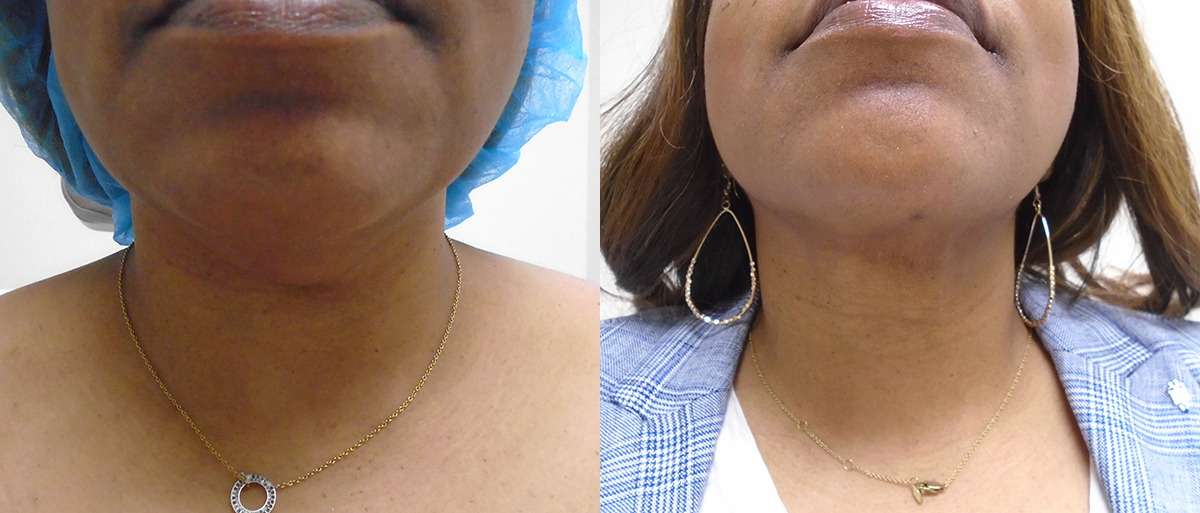 Liposuction Before and After Photo by Dr. Hennessy in Houston Texas
