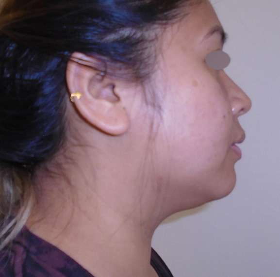 Chin Liposuction Before Photo by Downsize! Lipo Center of Houston in Houston, TX