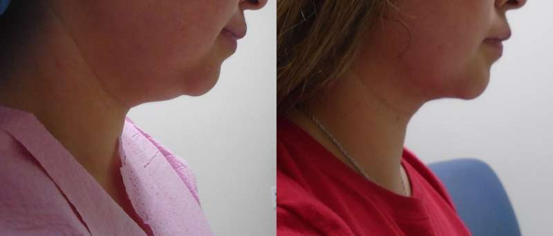 Submental before and after chin Houston, TX