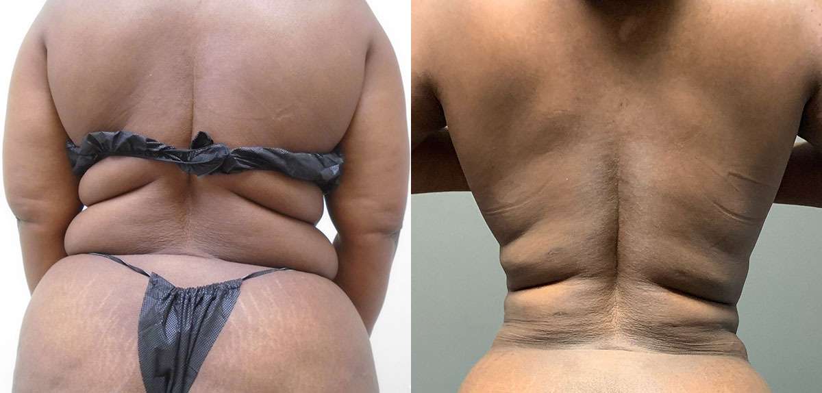 Liposuction 360 Before and After Photo by Dr. Hennessy in Houston Texas