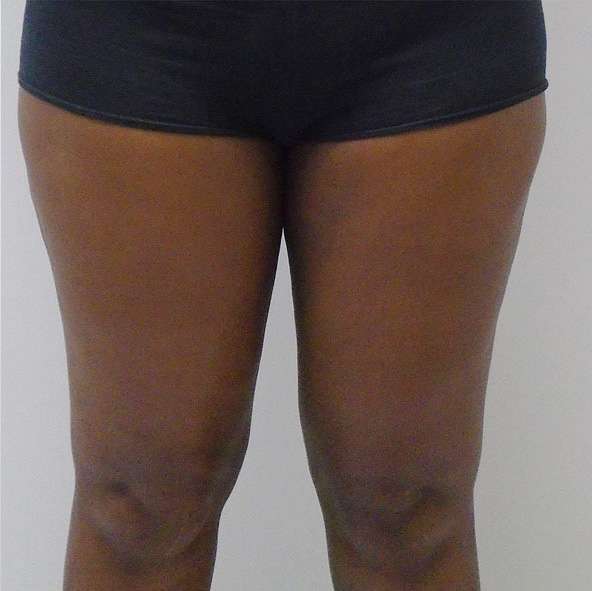 Inner Thighs After photo by Mark Hennessy, MD of Downsize! Lipo Center of Houston in Houston, TX