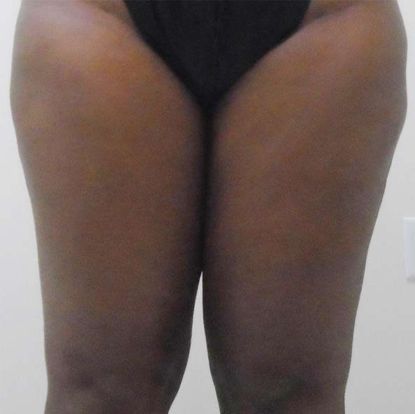 Inner Thighs Liposuction Before photo by Mark Hennessy, MD of Downsize! Lipo Center of Houston in Houston, TX