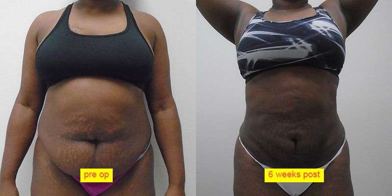 Liposuction 360 Before and After Photo by Dr. Hennessy in Houston TX