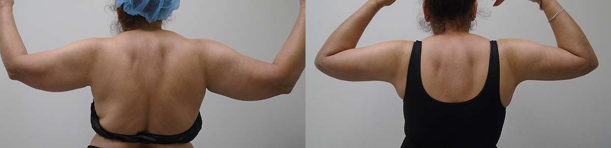 Before and after Right Arm Downsize Lipo