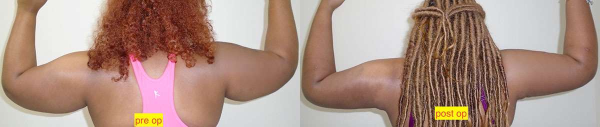 Arm Lift Before and After Photo by Downsize Lipo Center in Houston TX