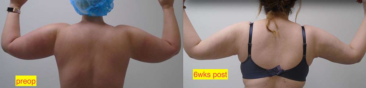 Arm Lift Before and After Photo by Downsize Lipo Center in Houston TX