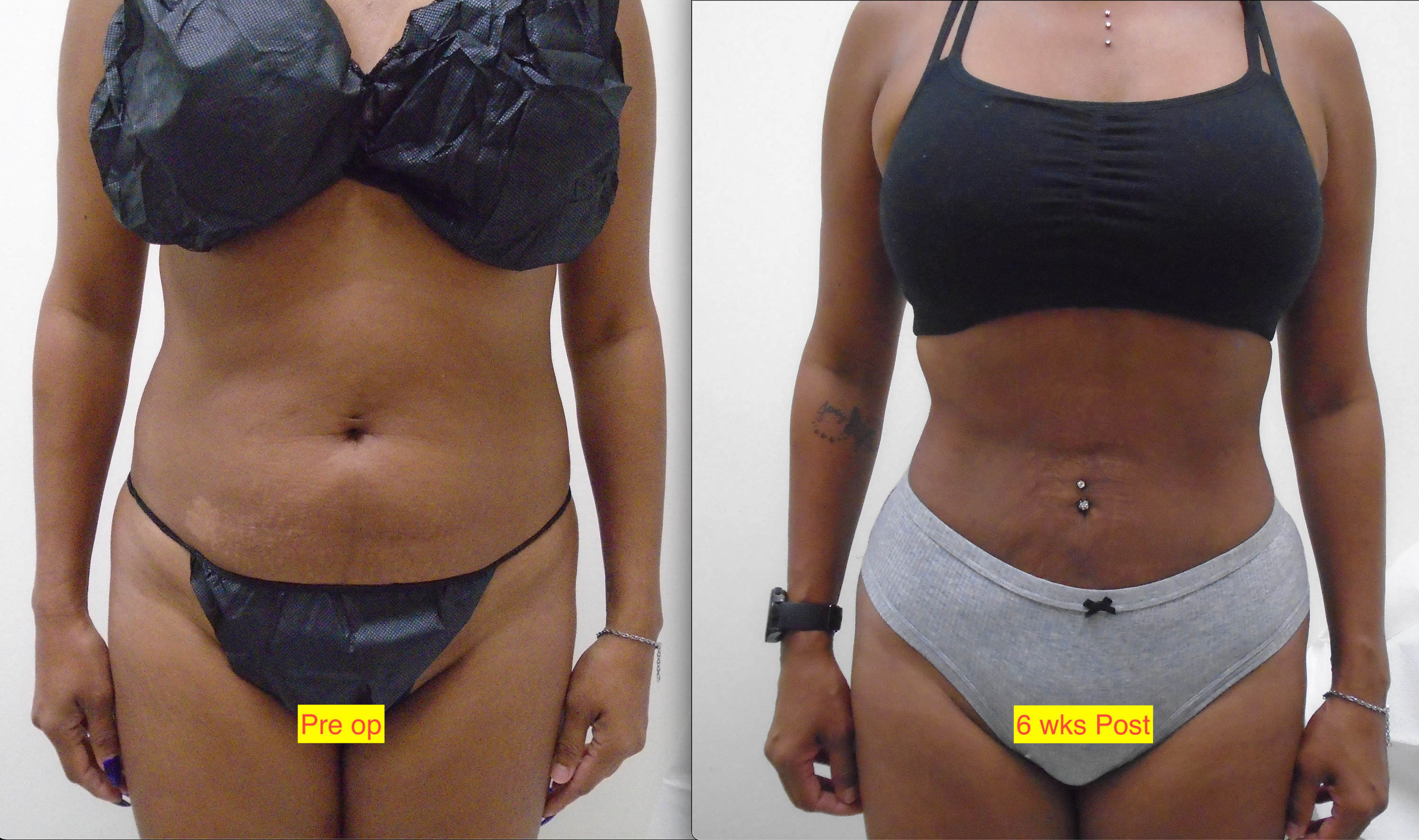 Liposuction Before and After Photo by Downsize Lipo Center in Houston TX